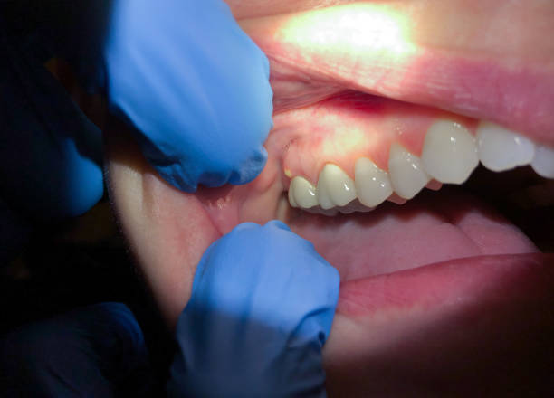 Best Chipped Tooth Repair Near Me  in Solomon, KS